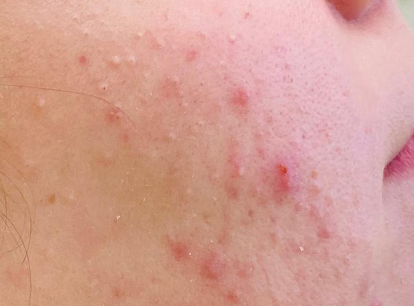 Aknebehandlung und Behandlung im Kosmetikstudio Duisburg, Hautpflege gegen Pickel.